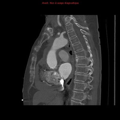 Dissection aortique et tamponnade post-TAVI (Transcatheter Aortic Valve Implantation)