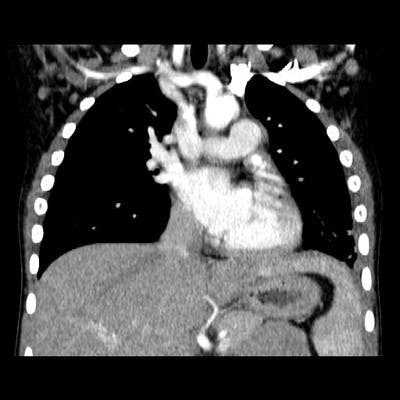 Pneumopathie lobaire inférieure gauche secondaire à un carcinome muco-épidermoïde dévoloppé aux dépens de la bronche lobaire inférieure gauche