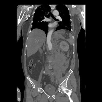 Rupture d'un anévrysme de l'aorte abdominale.