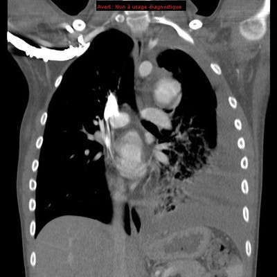 Hémothorax sur fissuration dans la cavité pleurale d'un anévrisme de l'aorte thoracique descendante