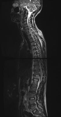 Fracture instable de T12 en hyperflexion associant fracture tassement corporéal, fracture - luxation bilatérale des massifs articulaires et lésions disco-ligamentaires inter épineux, sur épineux et du ligament jaune.