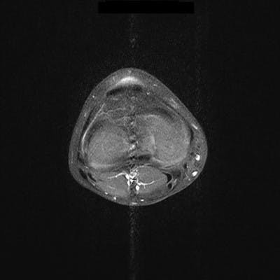 Granulome annulaire profond en avant du tendon rotulien