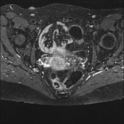 Cancer du col utérin étendu sur 20 mm de hauteur et de grand axe transversal avec doute sur une atteinte du paramètre gauche (interruption d'un anneau fibreux péri-cervical) : probable stade II b