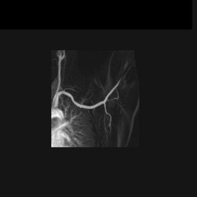 Syndrome du défilé thoraco-brachial artériel gauche.