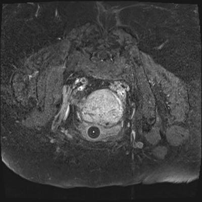 Tumeur du col utérin, envahissant la cavité endométriale, prolabée dans le vagin, envahissant le paramètre droit, avec urétéro-hydronéphrose bilatérale, adénomégalies  et lésion secondaire ovarienne droite.