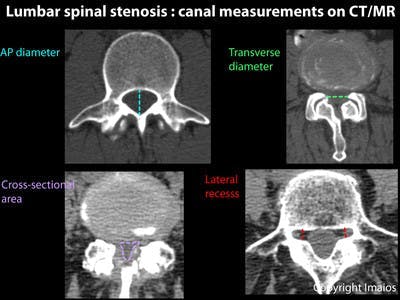 Spinal stenosis, Radiology Reference Article