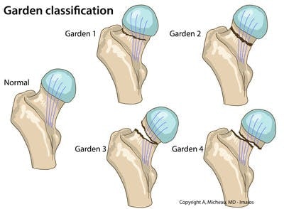 Garden-Classification-Femoral-neck-fractures
