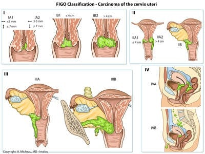 FIGO-Classification-Carcinoma-of-the-cervix-uteri