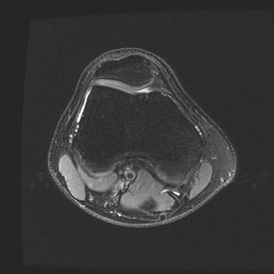  MRI Lower limb Axial Fat Sat DPw