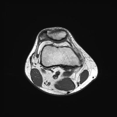  MRI Lower limb Axial T1w