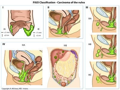 FIGO-Classification-Carcinoma-of-the-vulva