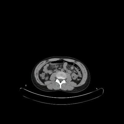 Body-Low Dose CT