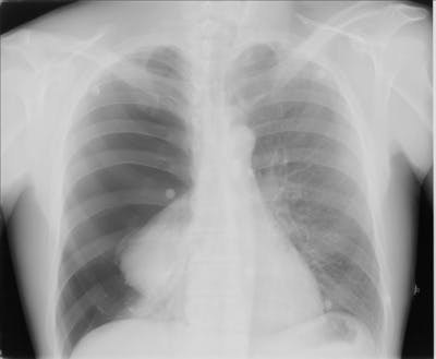 AP Chest X-ray