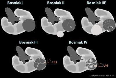 bosniak-classification-renal-cysts