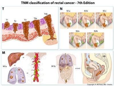 TNM-rectum-cancer-staging