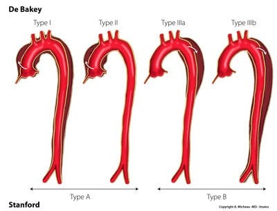 Aortic dissection : Stanford and De Bakey Classifications