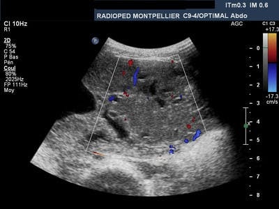  Echographie Axial