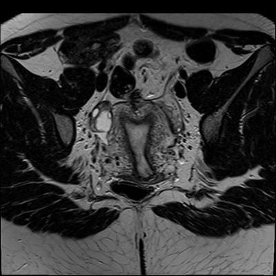  IRM Pelvis coronal par rapport à l'utérus T2