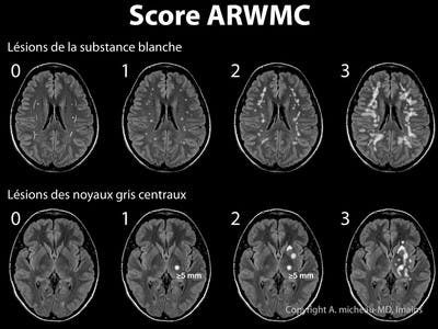 Echelle ARWMC (Age-Related White Matter Changes)