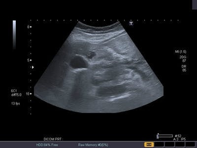  Echographie abdominale