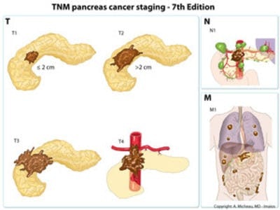Pancreas cancer staging