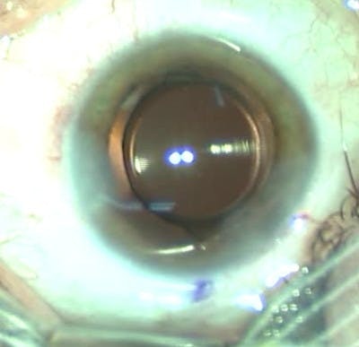 Cataracte sous capsulaire postérieure et astigmatisme cornéen - Implantation multifocale torique
