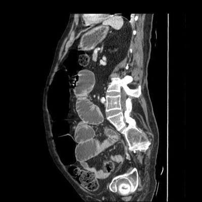 TDM abdomen pelvis sagittal veineux
