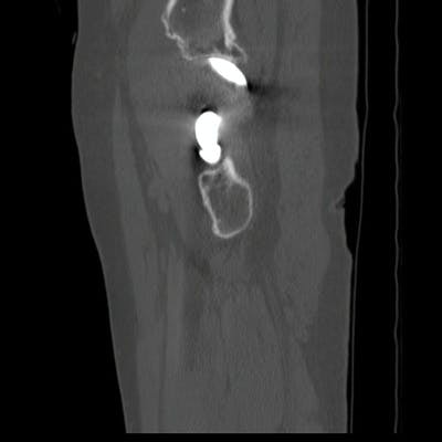 2-Descellement granulomateux et fracture sur prothèse de type B