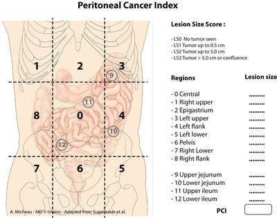 peritoneal-cancer-index