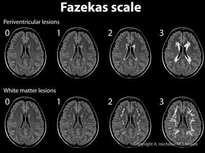 Fazekas scale in ARWMC scale on MRI