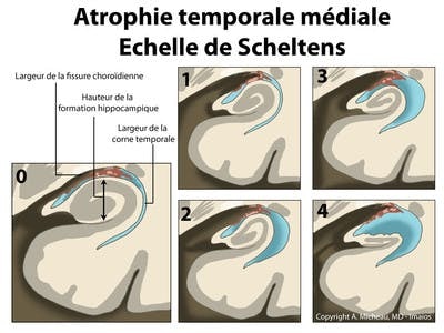 Atrophie hippocampique (Scheltens)