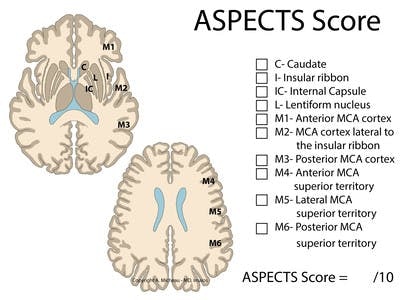 ASPECTS Score in acute stroke
