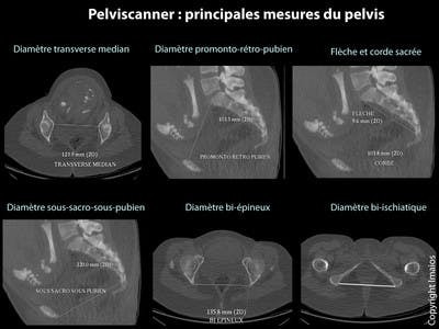 Dimensions du pelvis en obstétrique