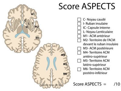 Score ASPECTS - Evaluation d’un  AVC ischémique cérébral moyen