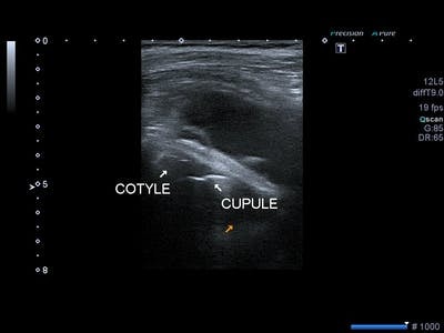 9-Bursite du muscle ilio-psoas: conflit cupule /psoas