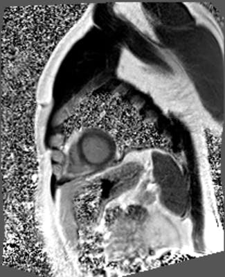 Infarctus du myocarde localisé au ventricule droit