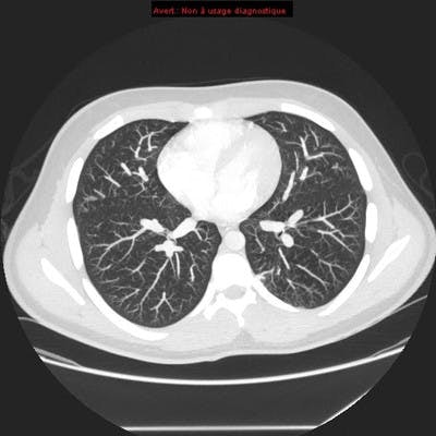 Hereditary hemorrhagic telangiectasia with lung arteriovenous malformation