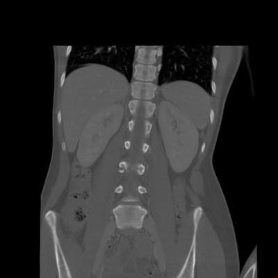 Fracture de Chance de L3 avec dissection post traumatique de l'aorte abdominale.