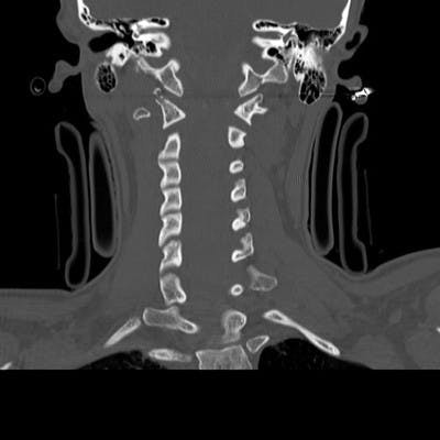 Hématome épidural cervical étendu avec fracture horizontal de l'arc antérieur de C1 se prologeant à l'articulaire droite avec fracture du condyle occipital gauche.